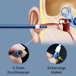 Ohren Gehörgang Stethoskop mit integrierter Kamera